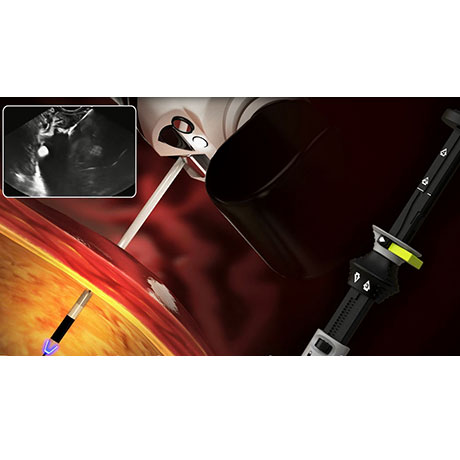 Vea cómo colocar el stent Hot AXIOS ™ y el sistema de entrega mejorado con electrocauterio