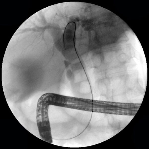 Jagwire™ High Performance Guidewire Boston Scientific