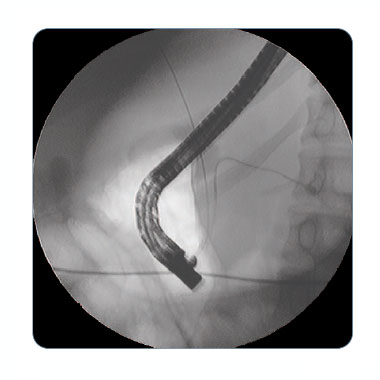 Fluoroscopic image of guidewire placement in common bile duct and pancreatic duct