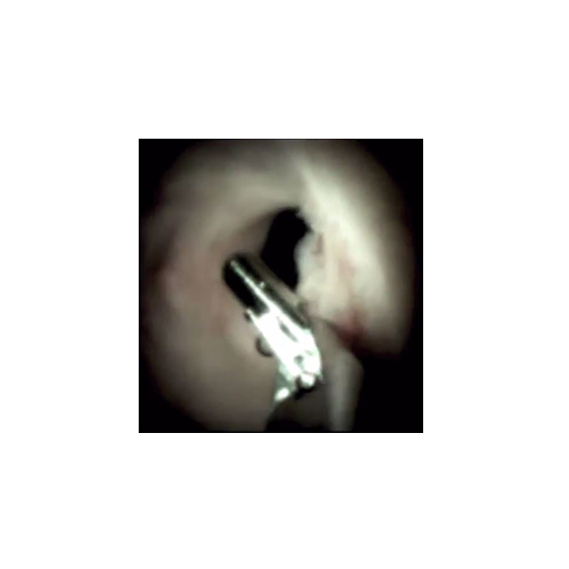 View of biopsy in biliary duct using the SpyGlass DS II System