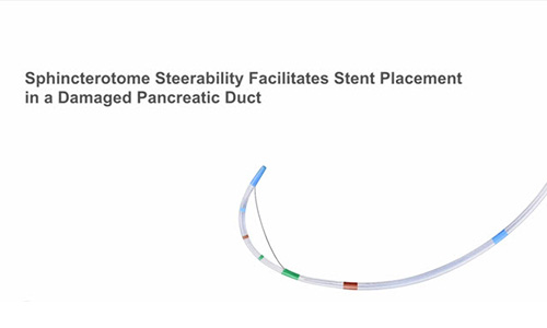 Sphincterotome Steerability Facilitates Stent Placement in a Damaged Pancreatic Duct