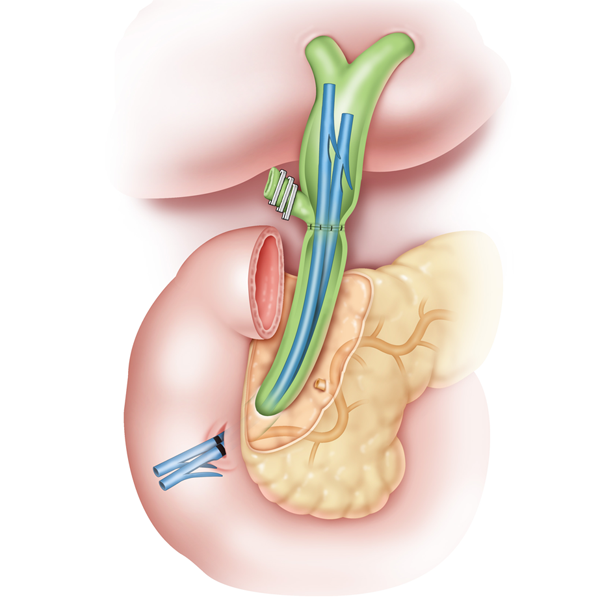 Illustration showing multi-stenting  in an anastomotic stricture post orthotopic liver transplant