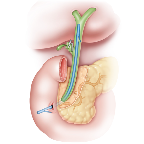 Illustration of stenting in a post-operative biliary fistula or leak