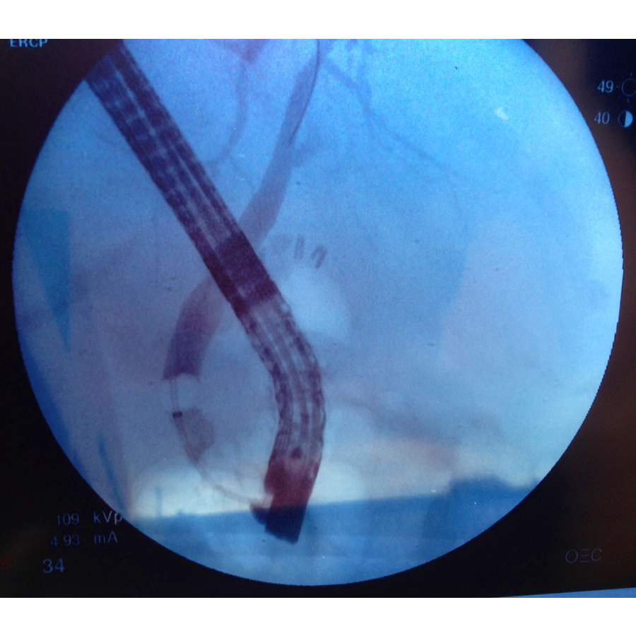 Flurosocopy image of inflated balloon in the bile duct; squared shoulders help maintain contact with duct walls