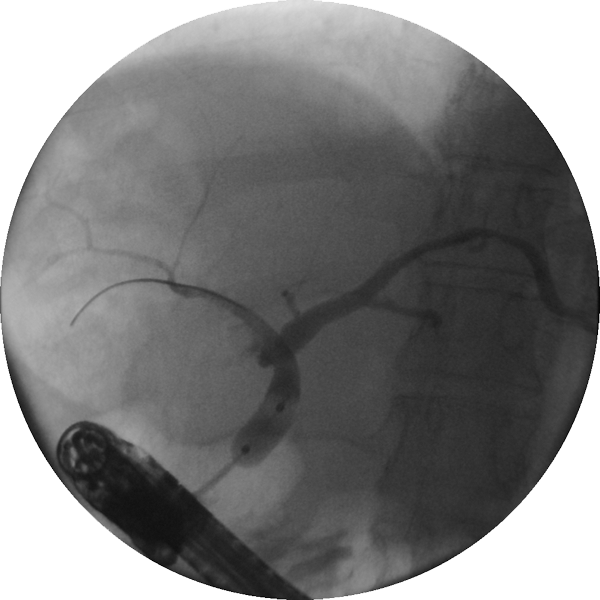 Dilation of a stricture with the Hurricane RX Biliary Balloon Dilatation Catheter