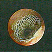 Stent das Vias Aéreas Polyflex em estenose traqueal benigna