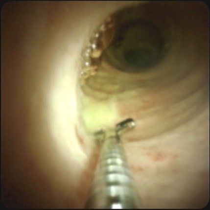 Endoscopic Image- (placement detailed under Physician and Patient Recourses)