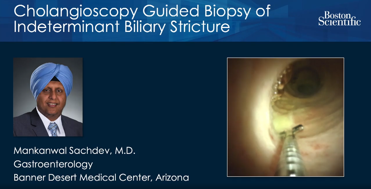 View Video: Indeterminate Biliary Stricture Case, Dr. Sachdev