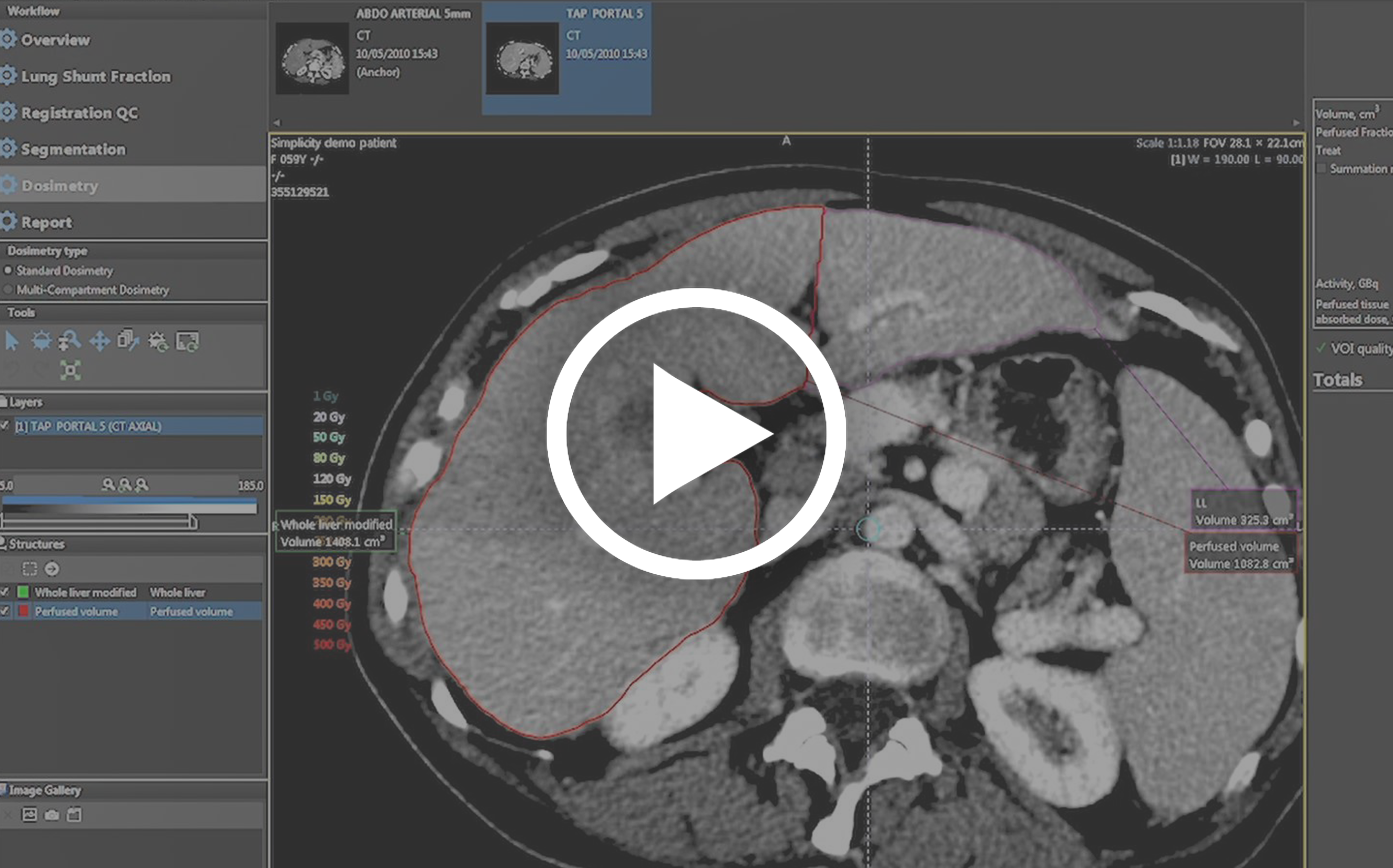 Simplicit90YTM demonstration video