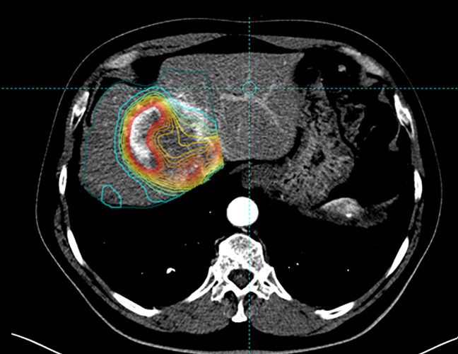 Personalise Dosimetry
