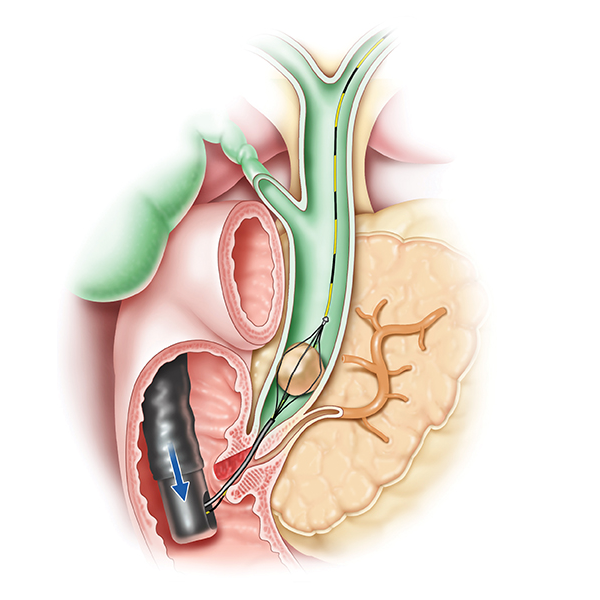 Illustration showing proper positioning of scope below papillary opening when removing the basket
