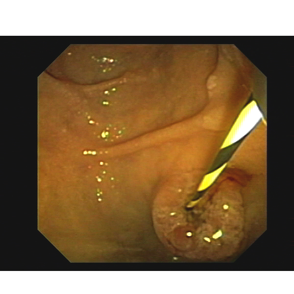 wireguided cannulation endoscopic image during ercp