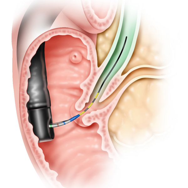wireguided cannulation guidewire enters bile duct