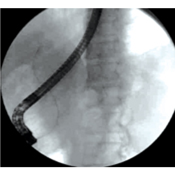 Wireguided Cannulation Boston Scientific