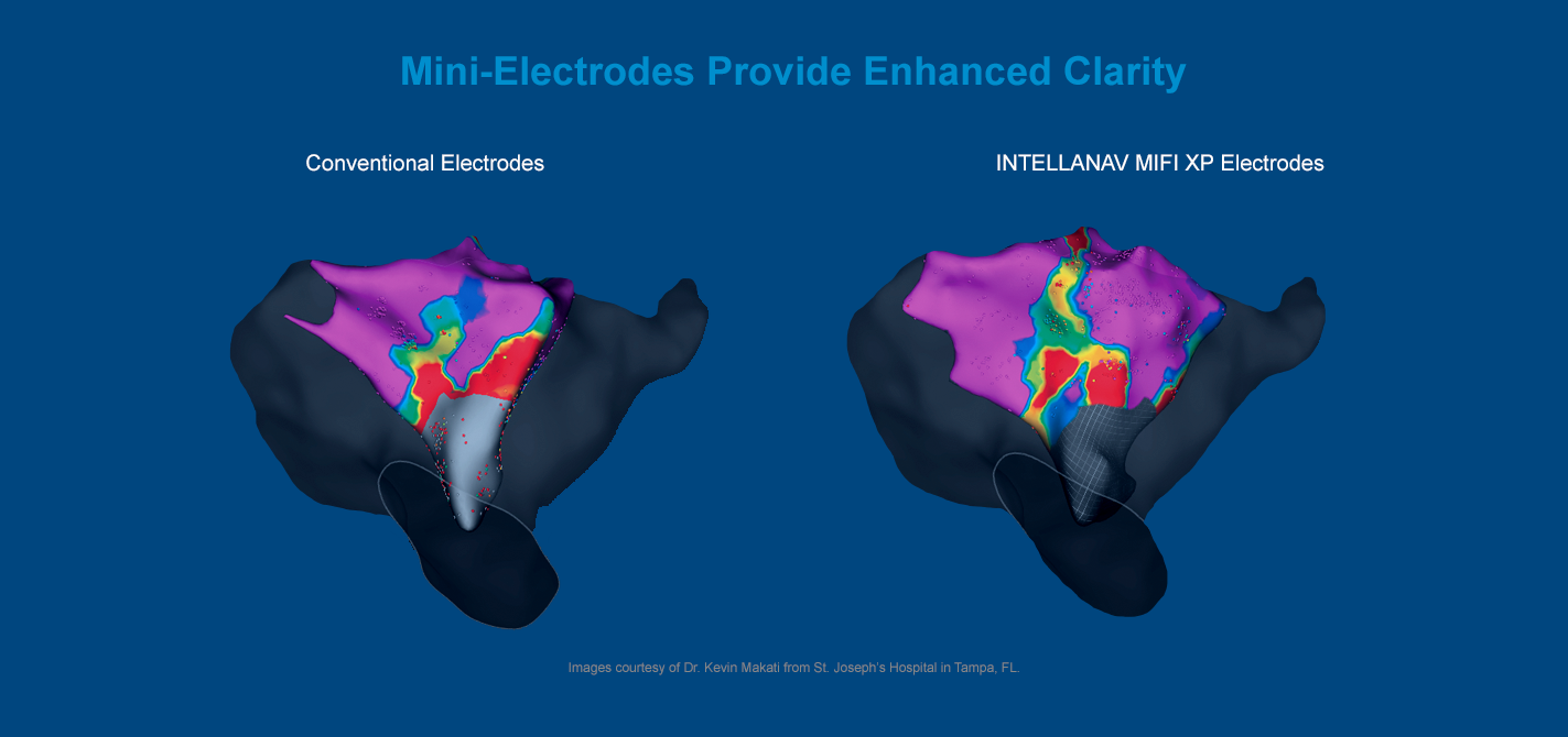 A comparison map shows the enhanced clarity offered by INTELLANAV MIFI XP Ablation Catheter electrodes versus standard electrodes.