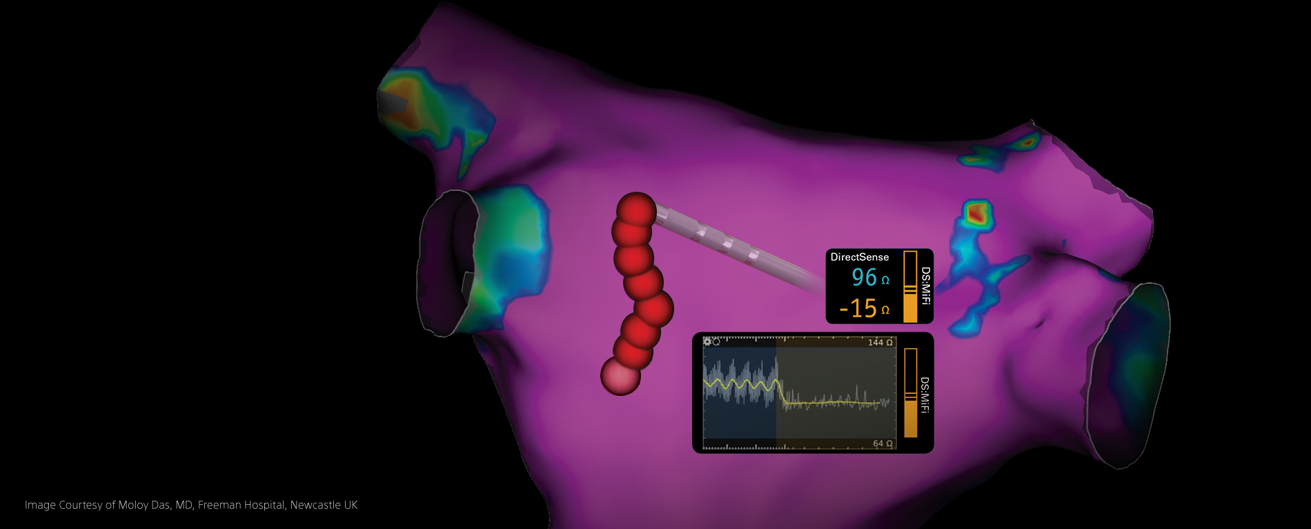 DIRECTSENSE™ Technology widgets showing the ohm drop during an RF ablation procedure with a high-definition cardiac map in the background.