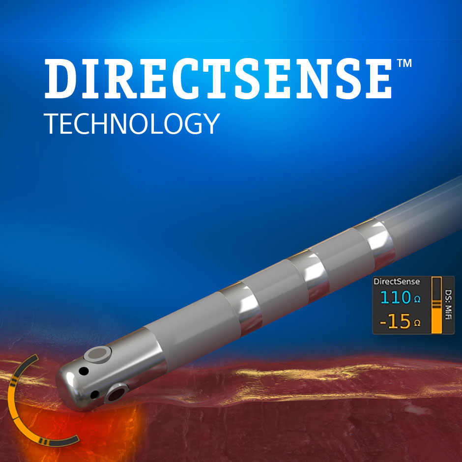 DIRECTSENSE™ Technology showing local impedance measurements at the tip of the INTELLANAV MIFI™ Open-Irrigated Ablation Catheter