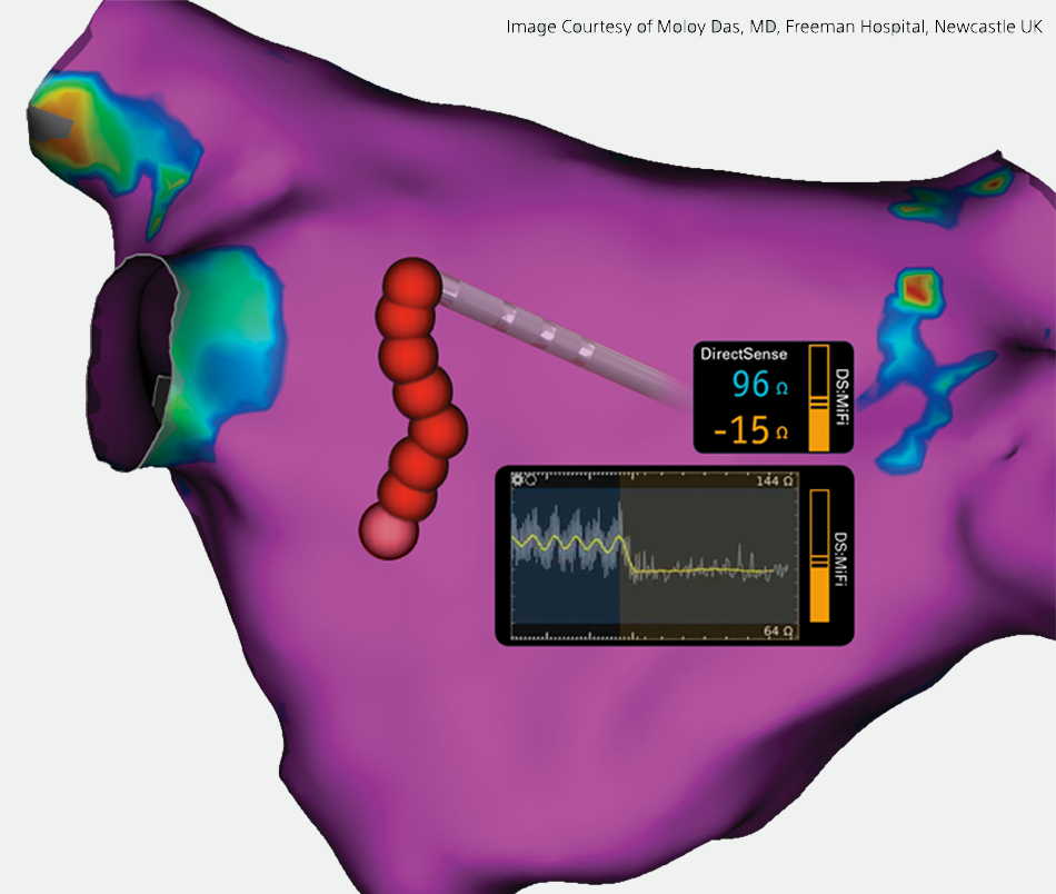 DIRECTSENSE™ Technology widgets showing the ohm drop during an RF ablation procedure with a high-definition cardiac map in the background.