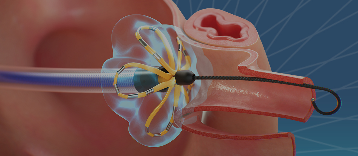 Interested in learning more? This curriculum comprises a series of lessons that covers the use of a pulsed field ablation approach for pulmonary vein isolation.