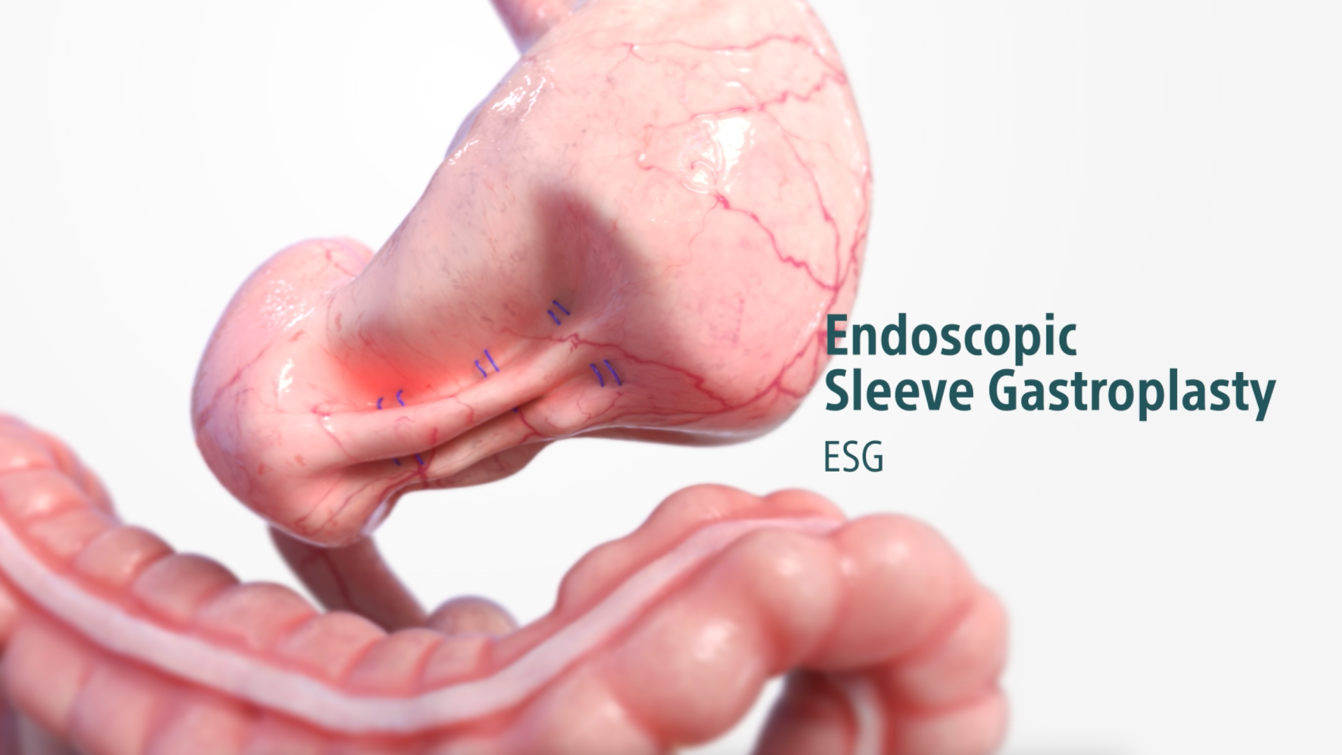 Endoscopic Sleeve Gastroplasty Animation