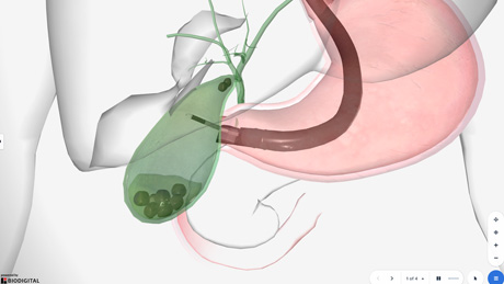 Gallbladder Drainage with Hot AXIOS™ Stent