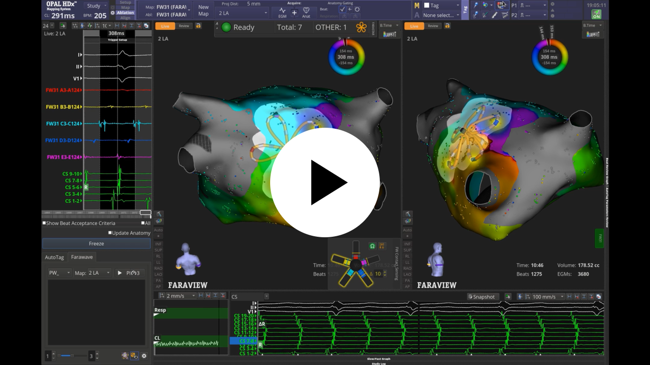 OPAL 7.0 Software: Enhance map quality and planning and assessment of therapy delivery during FARAPULSE™ PFA workflows on the OPAL HDx™ Mapping System.