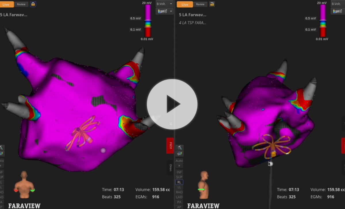 3D cardiac electroanatomical map showing atrial voltage mapping and catheter ablation visualization