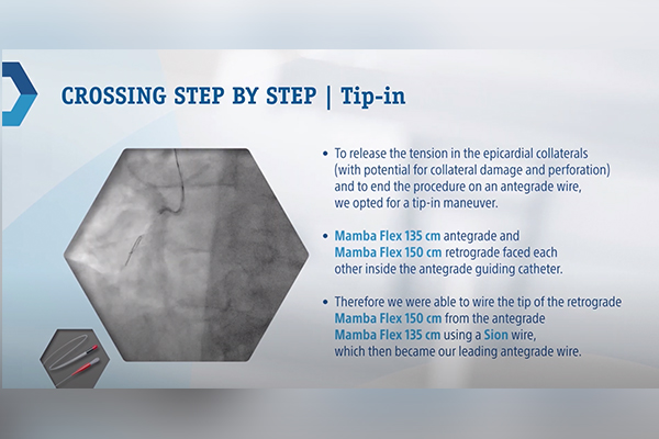 Complex Chronic Total Occlusion of the Right Coronary Artery - Watch the Video