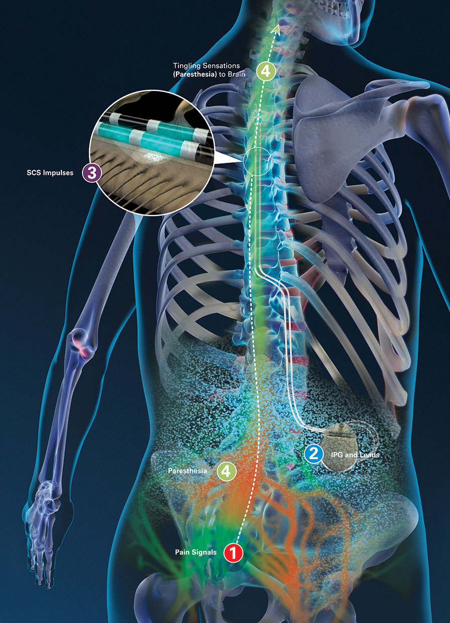 Diagram of IPG delivering SCS impulses in the human body