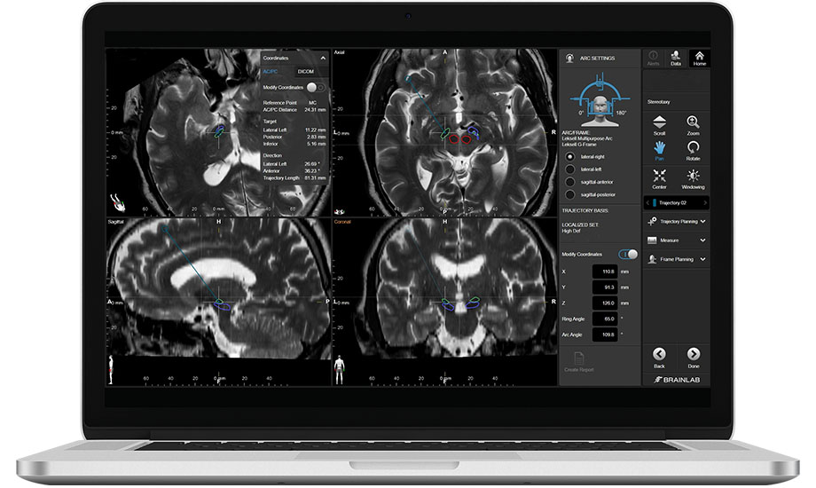 Screenshot of Vercise Neural Navigator 4 Programming Software interface with visualization of DBS lead.