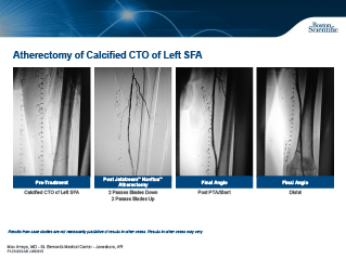 Aterectomia de CTO Calcificado