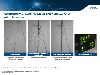 Aterectomia de AFS Distal Calcificada/ CTO Poplíteo com Trombo
