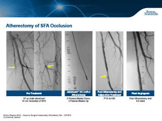 Aterectomia de CTO Calcificado de AFS Esquerda
