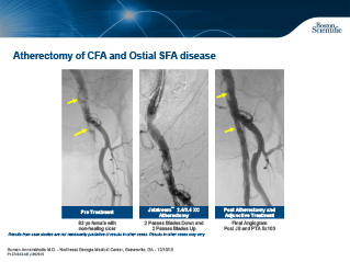 Aterectomia de AFS Calcificada