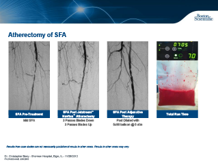 Aterectomia de CTO Excêntrico de 2 cm Calcificado