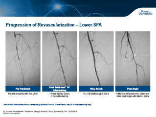 Aterectomia de AFS Calcificada Esquerda