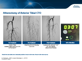 Aterectomia de AFS/ Poplíteo/ Tibial Anterior