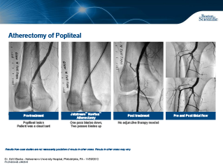Aterectomia de CTO Tibial Anterior