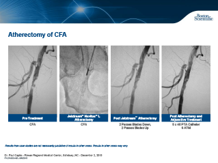 Aterectomia da Femoral Comum