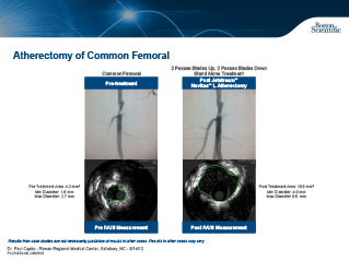 Aterectomia da Femoral Comum