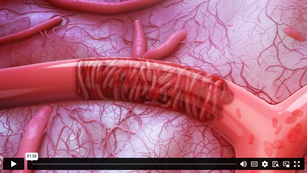 EMBOLD™ Detachable Coil System