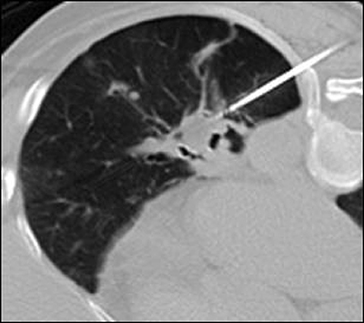 ECLIPSE study: scan for metastatic lung tumour with 1 Cryoablation needle insertion