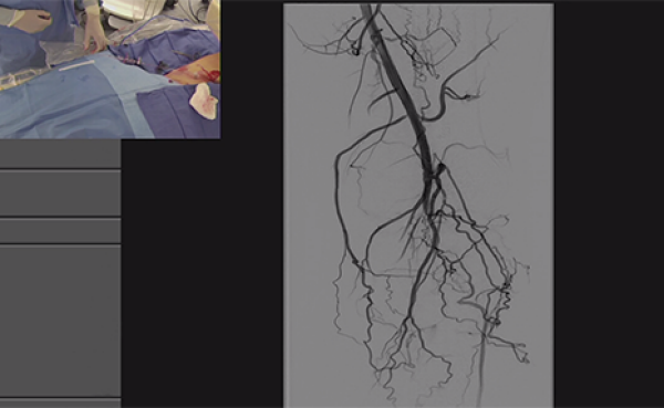 Jetstream Atherectomy Device : Jetstream 3D Atherectomy System – GMCRXG