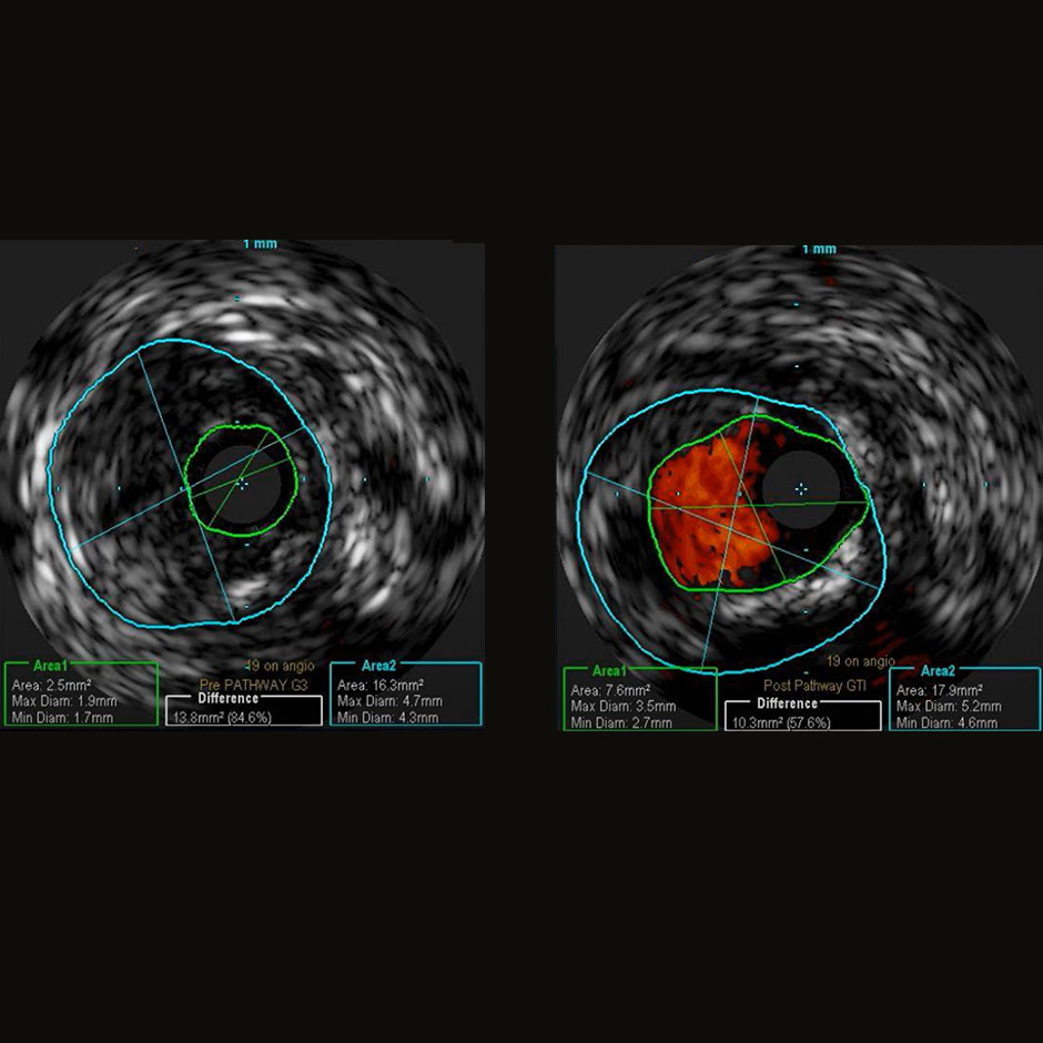 Dr. Thomas Shimshak perspective: consider using IVUS as a means of understanding the benefit of atherectomy