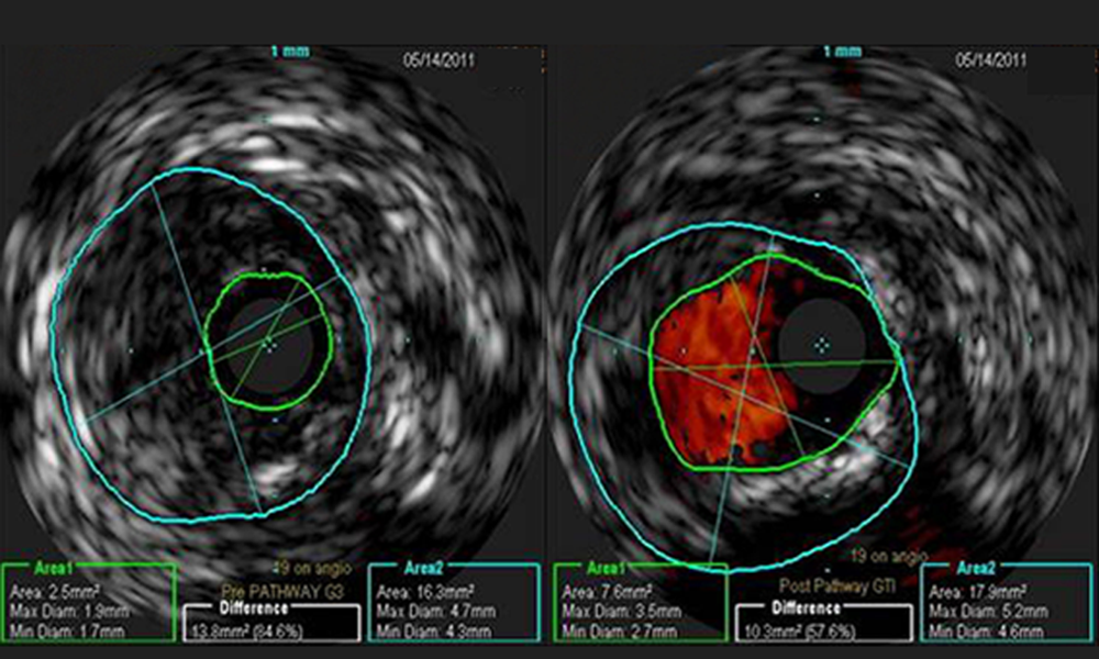 Expert Insights: The Role of IVUS in Atherectomy Procedures