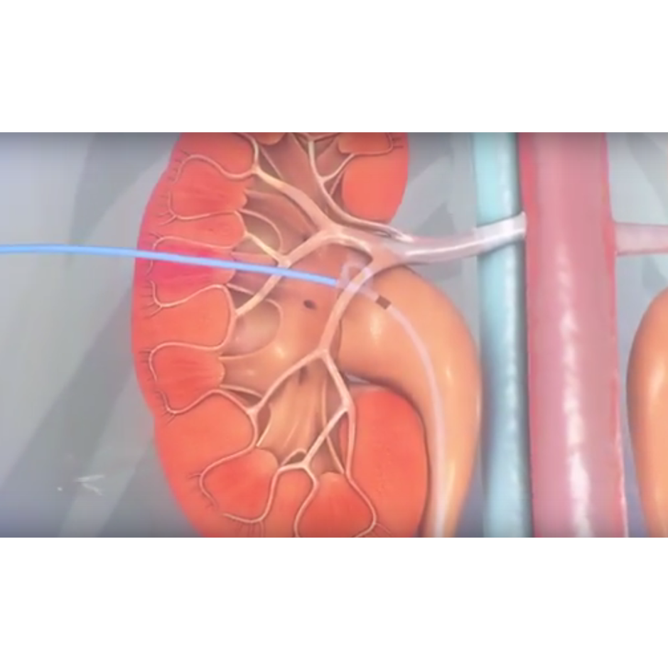 Expel™ Drainage Catheter with Twist-Loc™ Hub - Boston Scientific