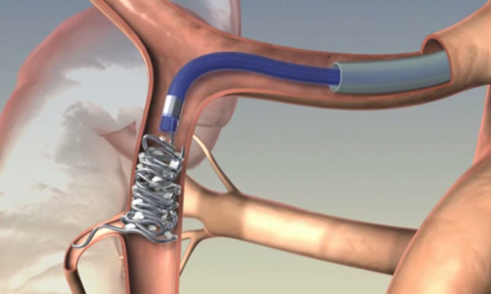Embolic Coil Y90 video.