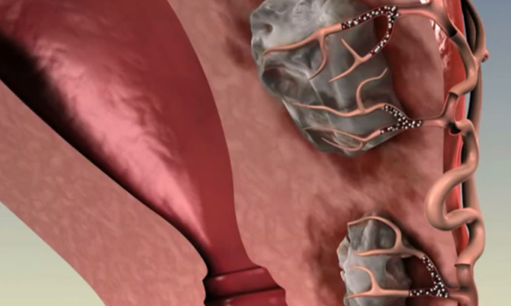 Uterine Artery Embolization video.