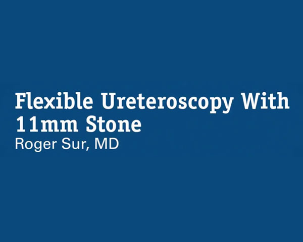 Ureteroscopia Flexível com Cálculo de 11 mm