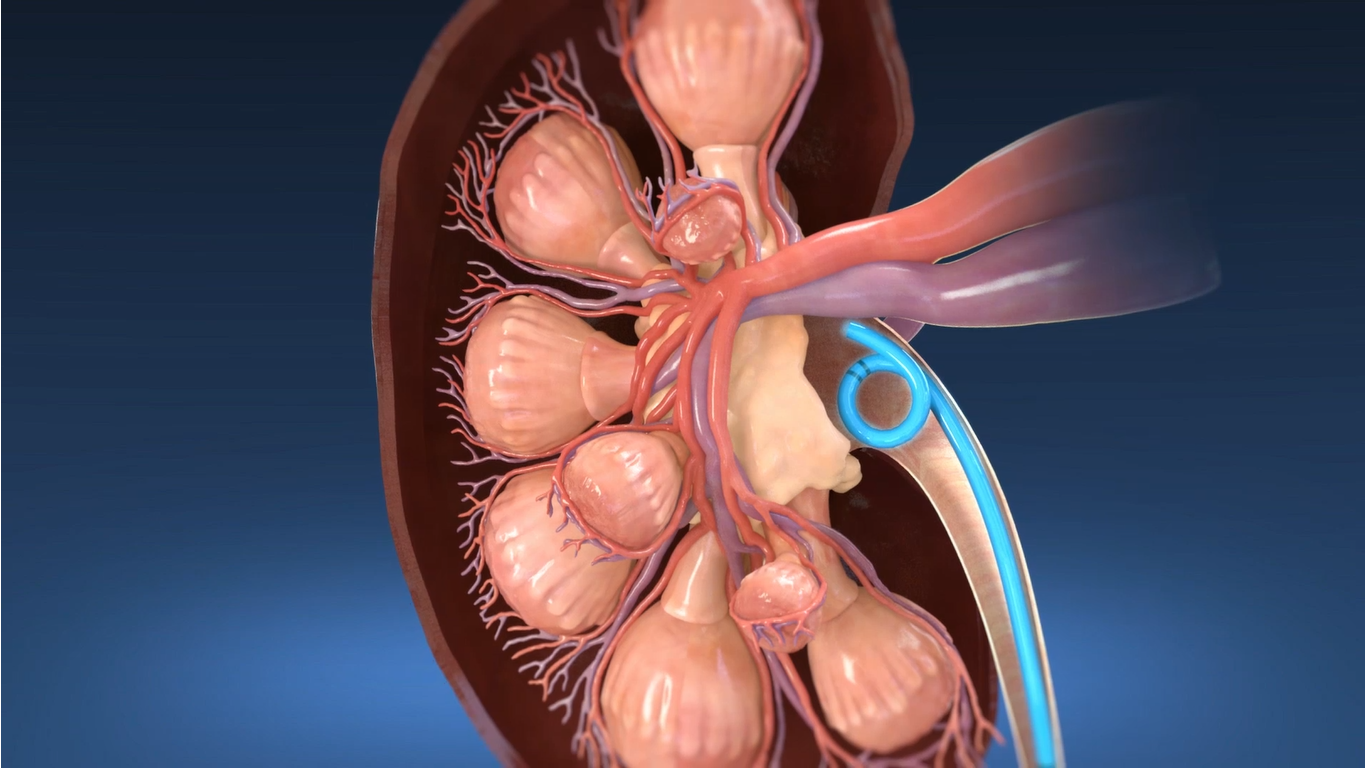 Informational video about ureteral stenst.